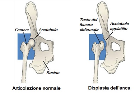 anca normale e con displasia